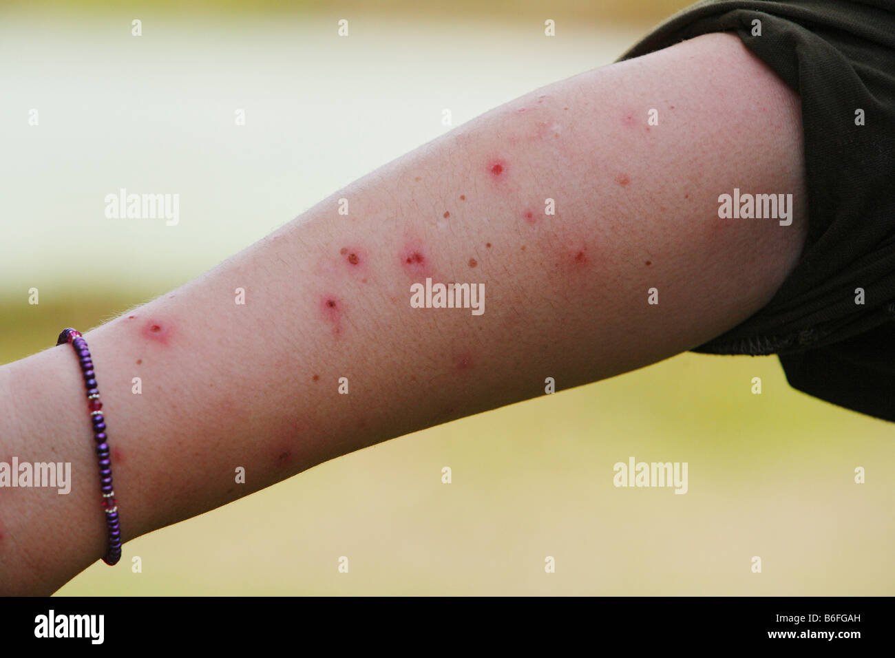 Arm covered in mosquito bites, Samboja, East Kalimantan / Kalimantan Timur, Borneo, Indonesia Stock Photo