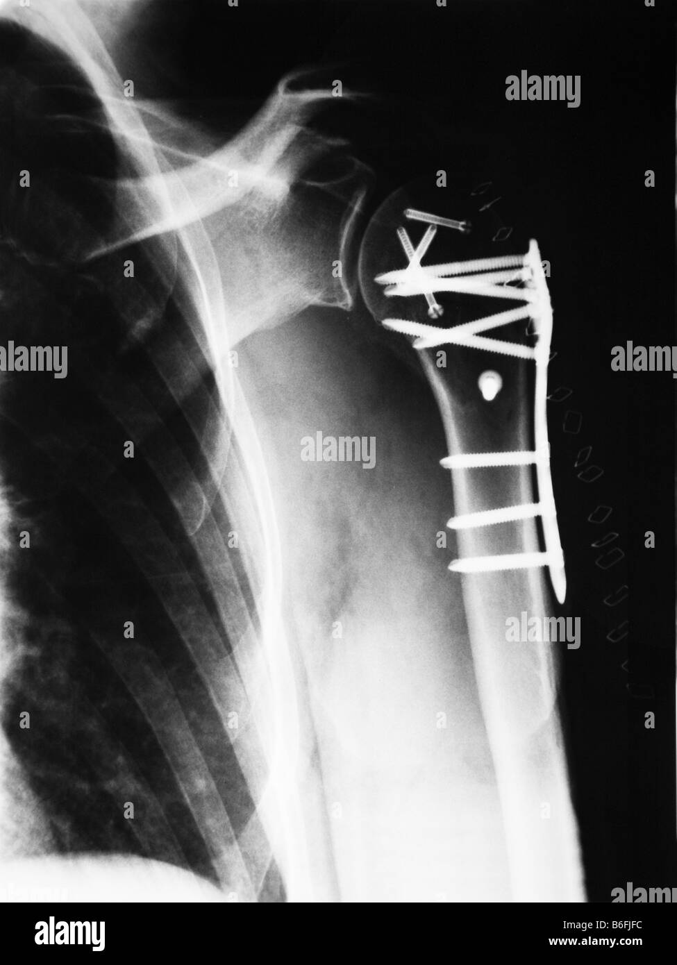 Xray of a broken upper arm after surgery, showing plates and screws
