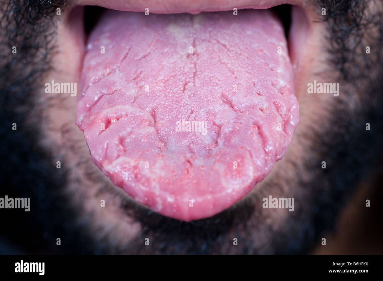 Geographic tongue Stock Photo