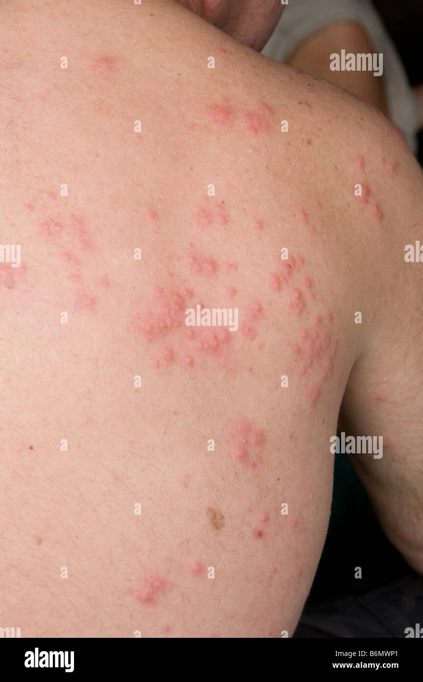 a man's back riddled with mosquito bites Stock Photo