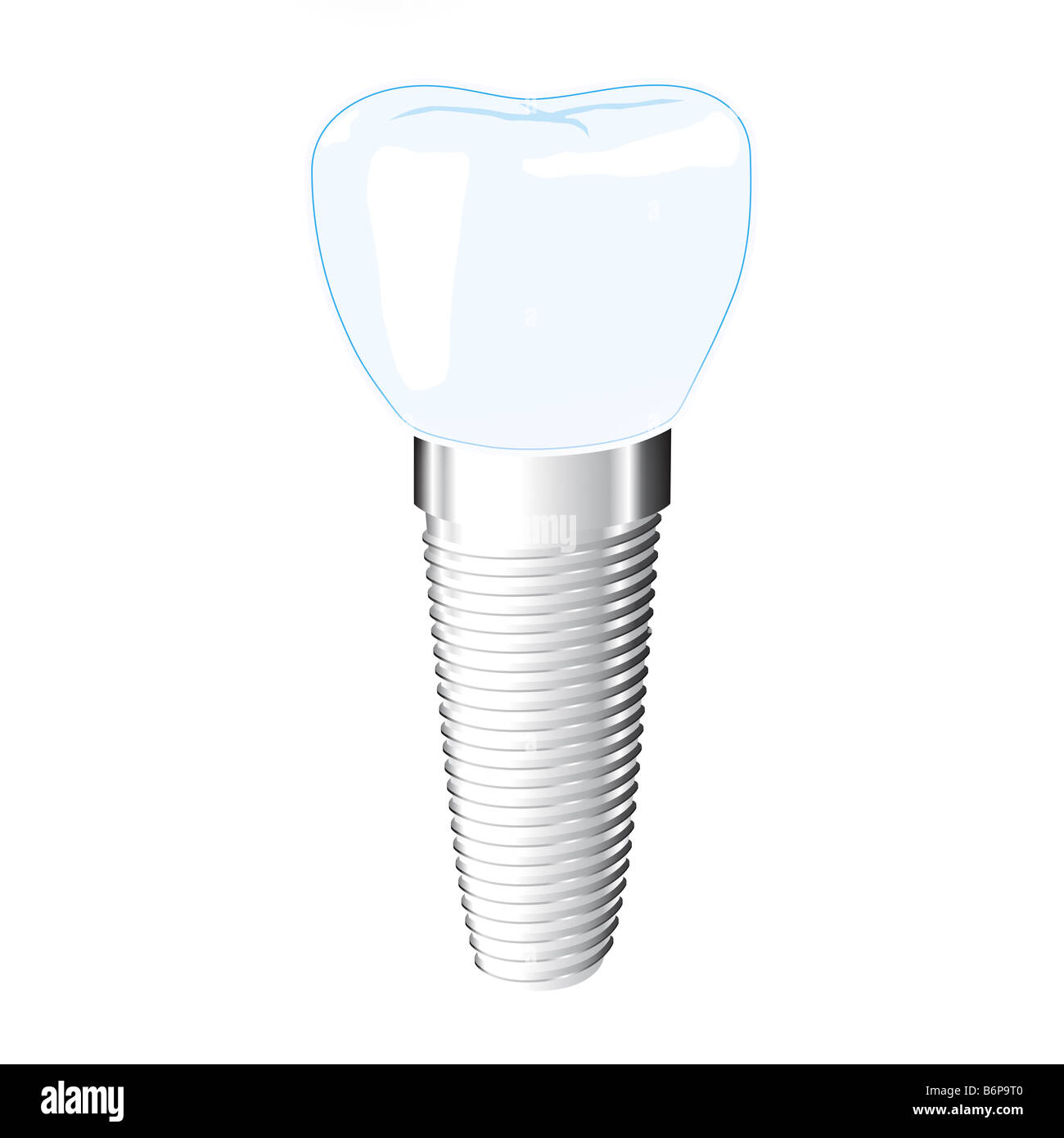 Dental implant Stock Photo