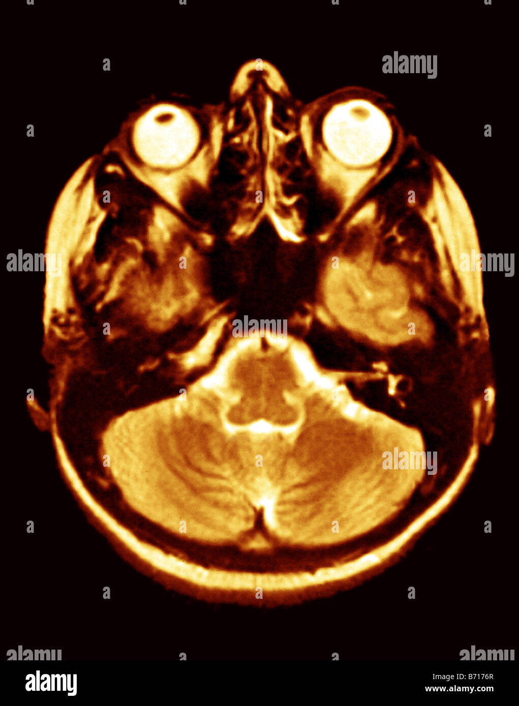 Brain scan mri hi-res stock photography and images - Alamy
