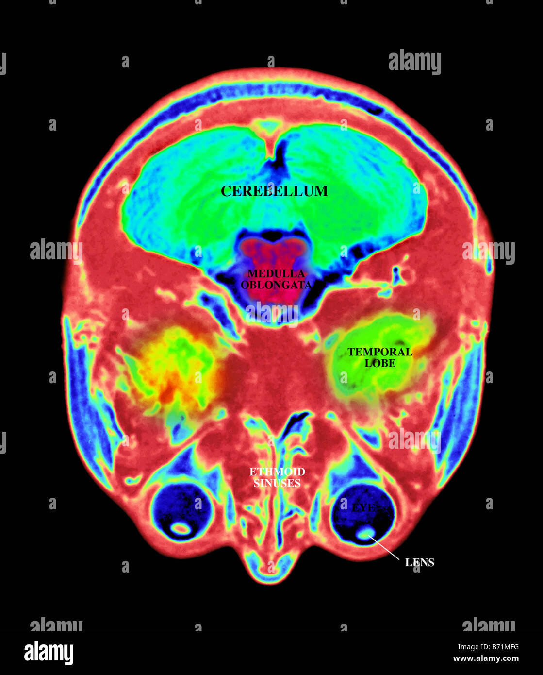 Mri brain scan hires stock photography and images Alamy