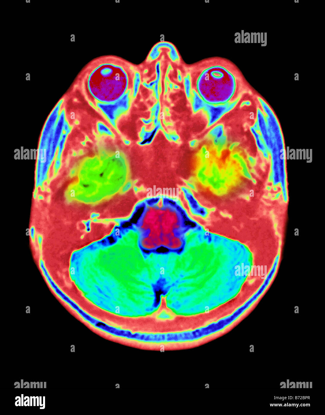 MRI scan of the brain Stock Photo Alamy