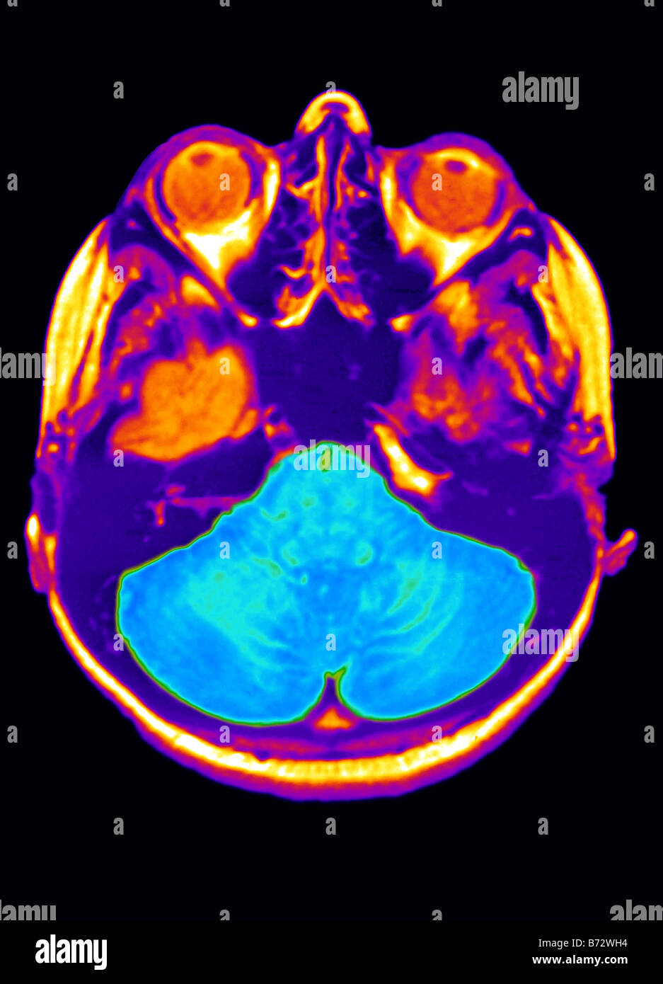 Mri scan of brain hi-res stock photography and images - Alamy