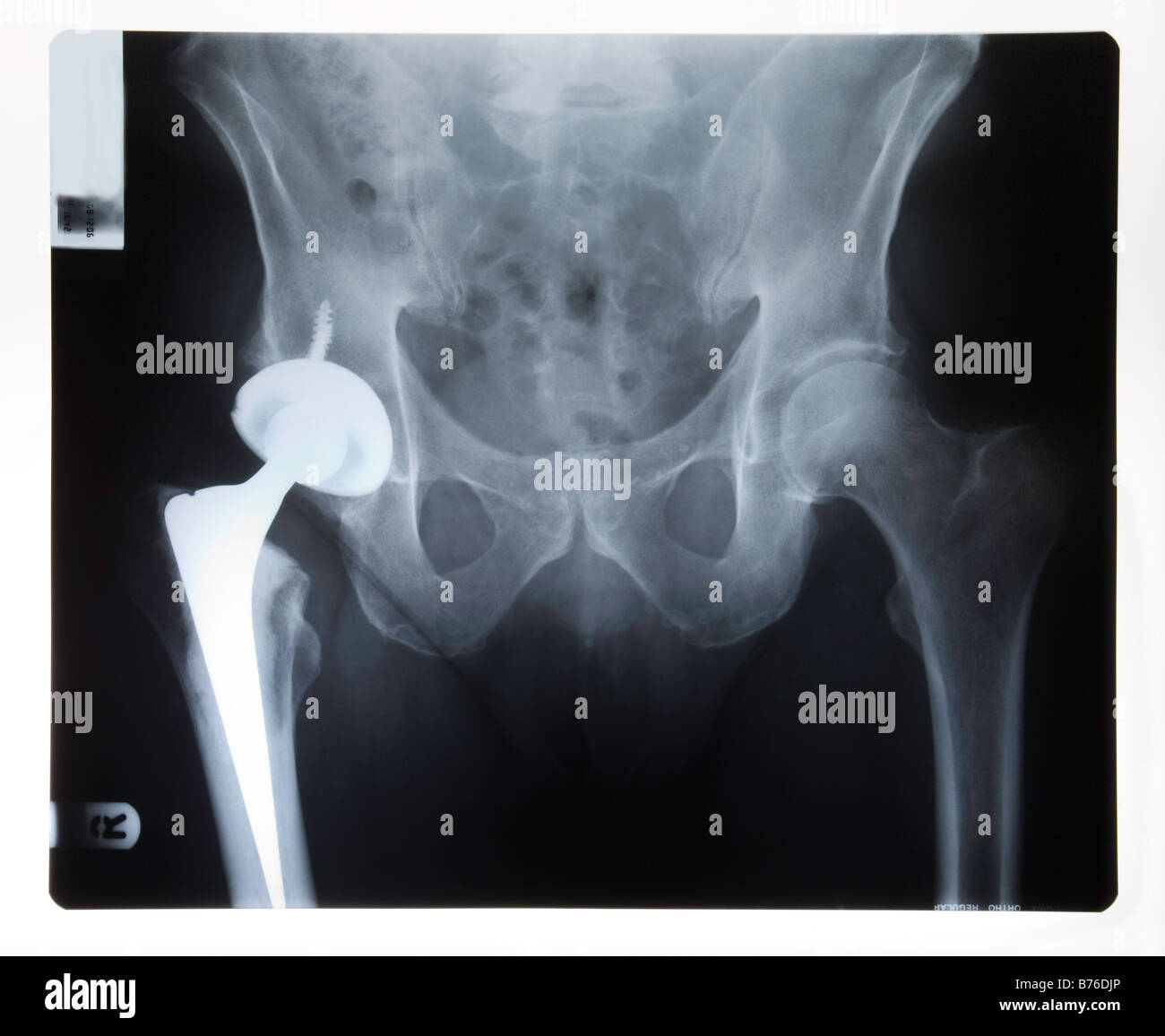 What is an Artificial Hip?