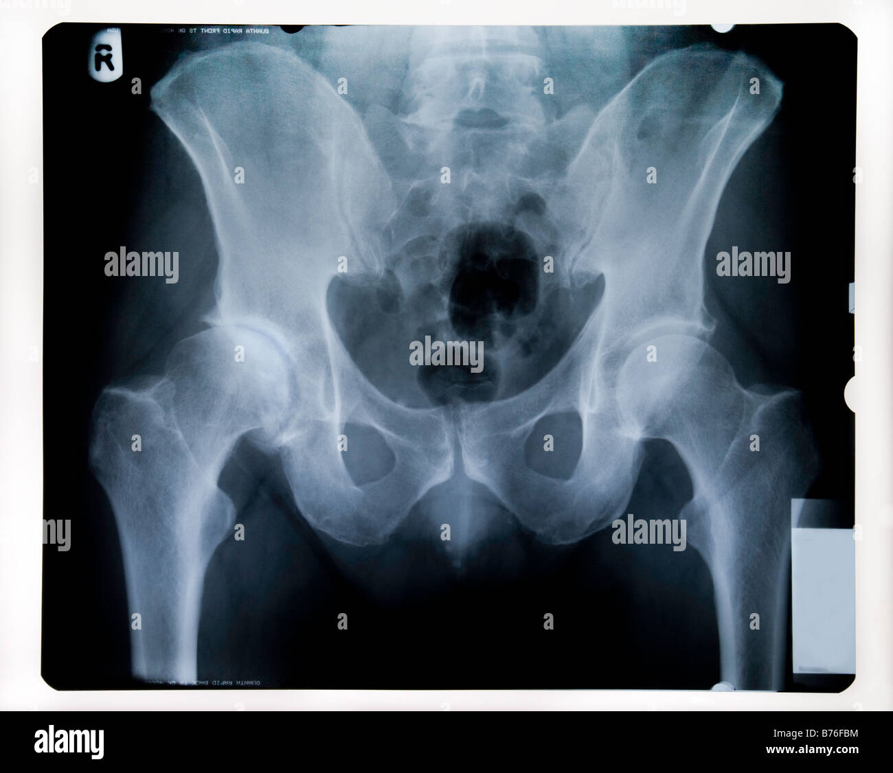 X-RAY OF MALE PELVIS WITH WORN HIP JOINT Stock Photo