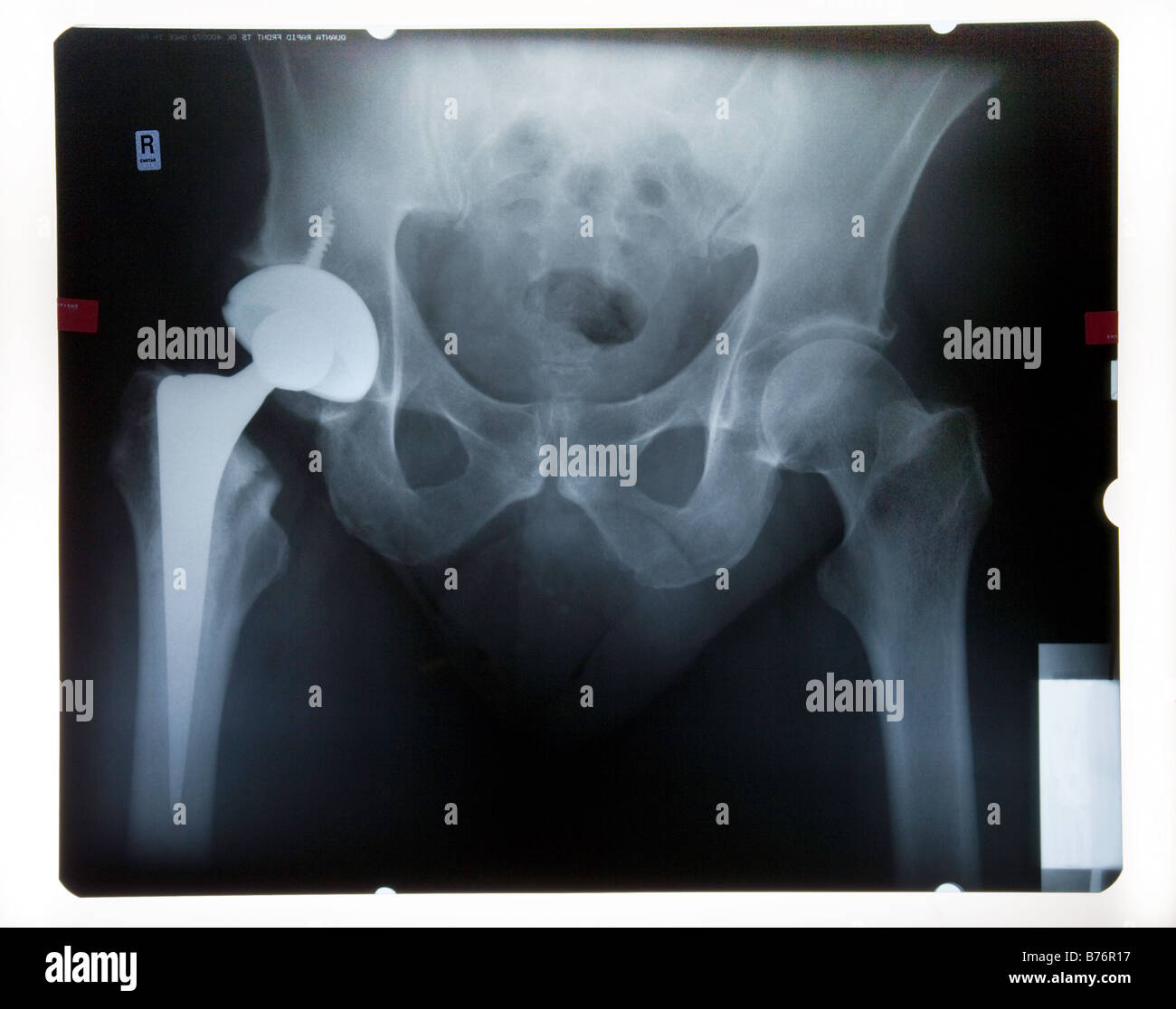 X-RAY OF MALE PELVIS WITH ARTIFICIAL HIP Stock Photo