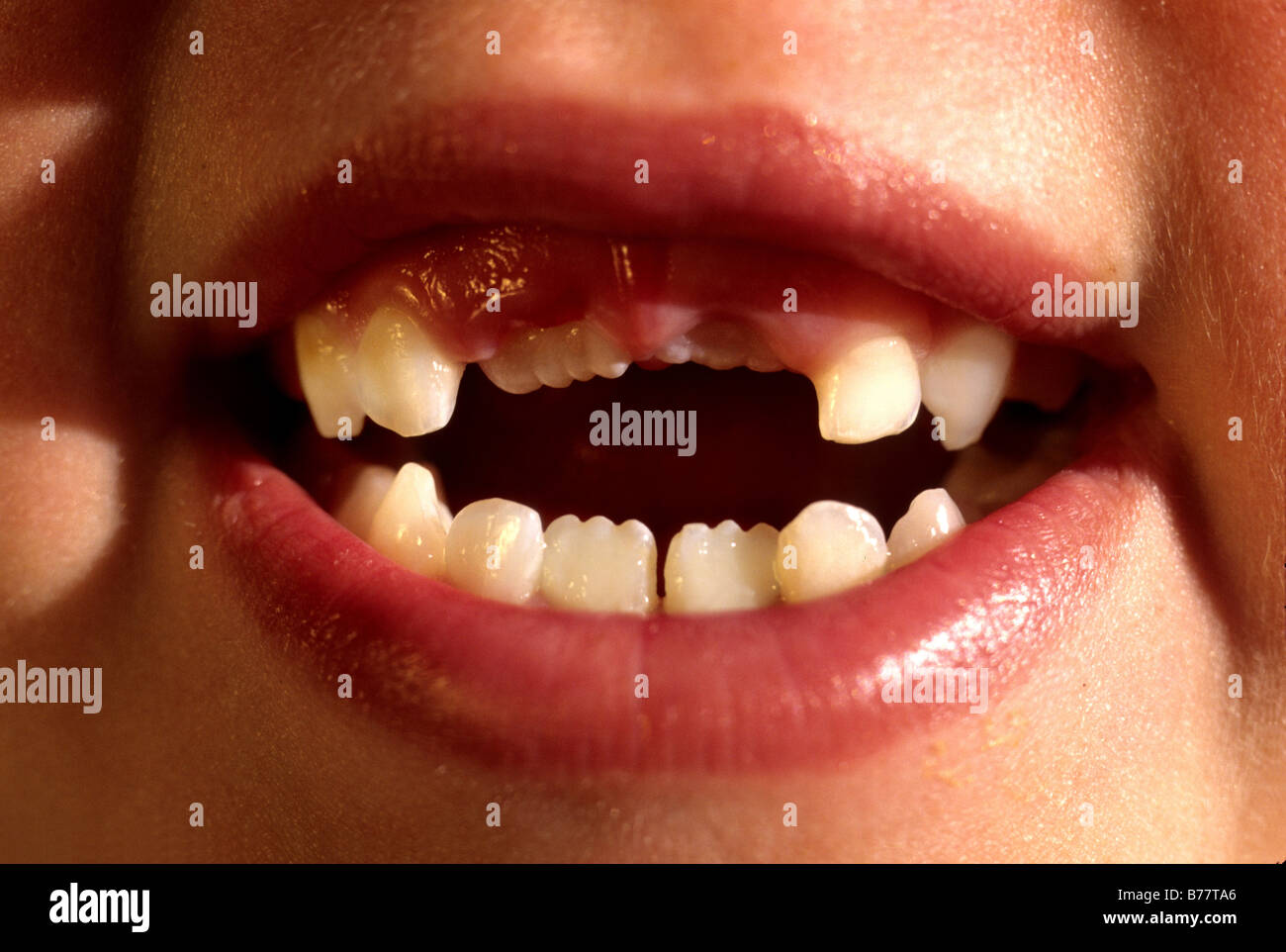 missing teeth smile model Released Stock Photo