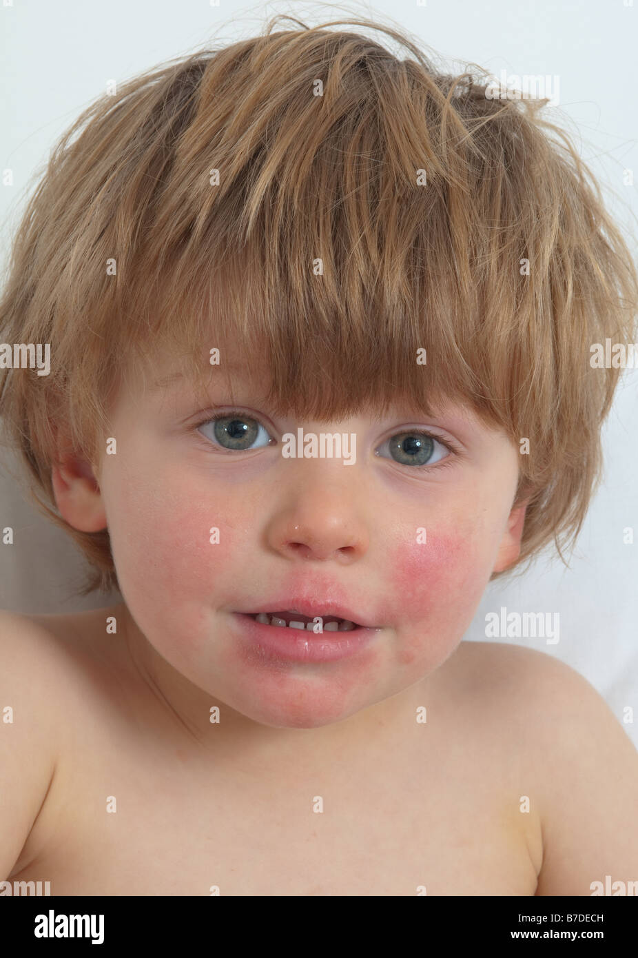 Ill little boy with a very sore face due to a prolonged cold and cough