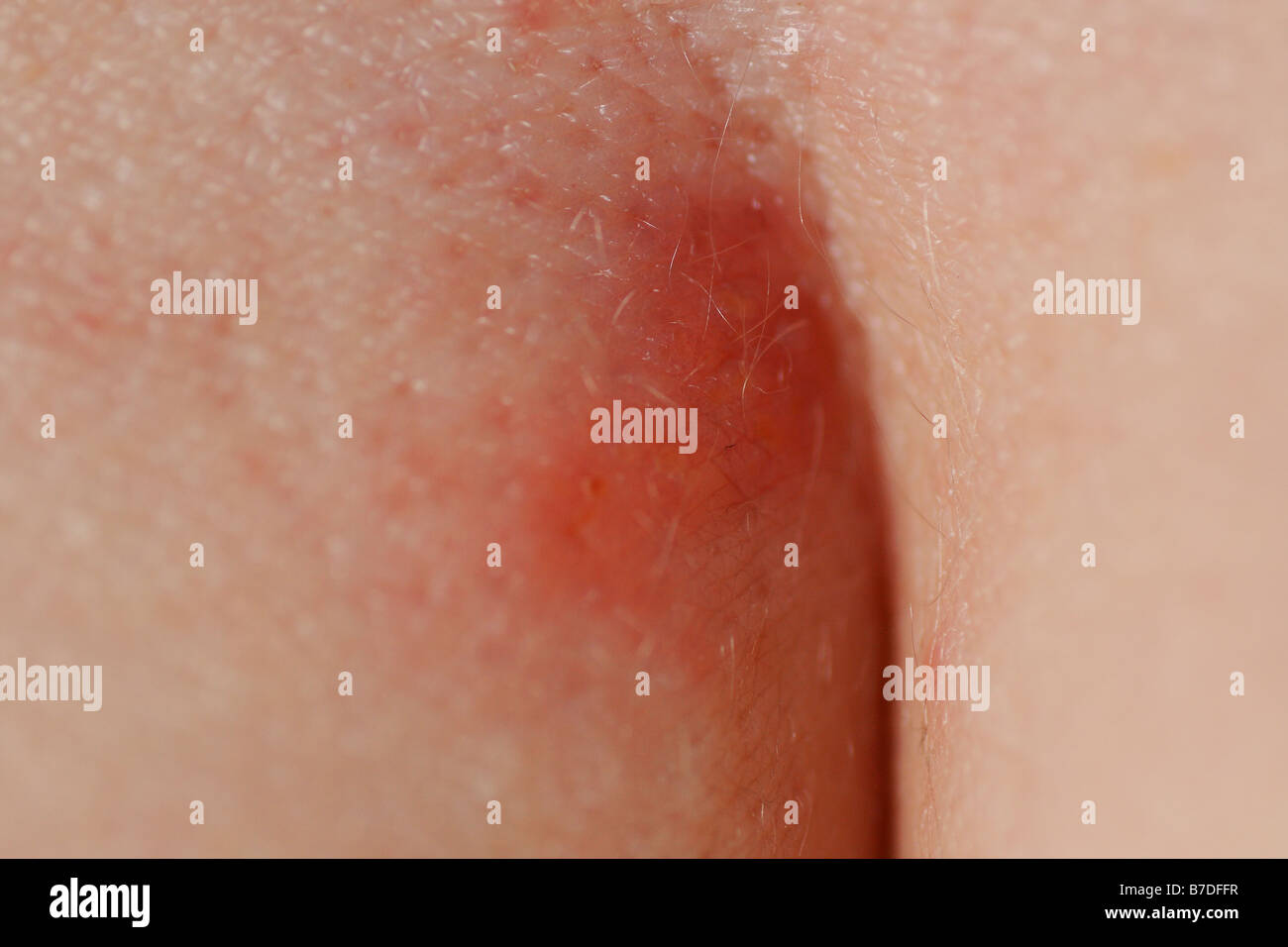 herpes zoster on a woman's behind Stock Photo