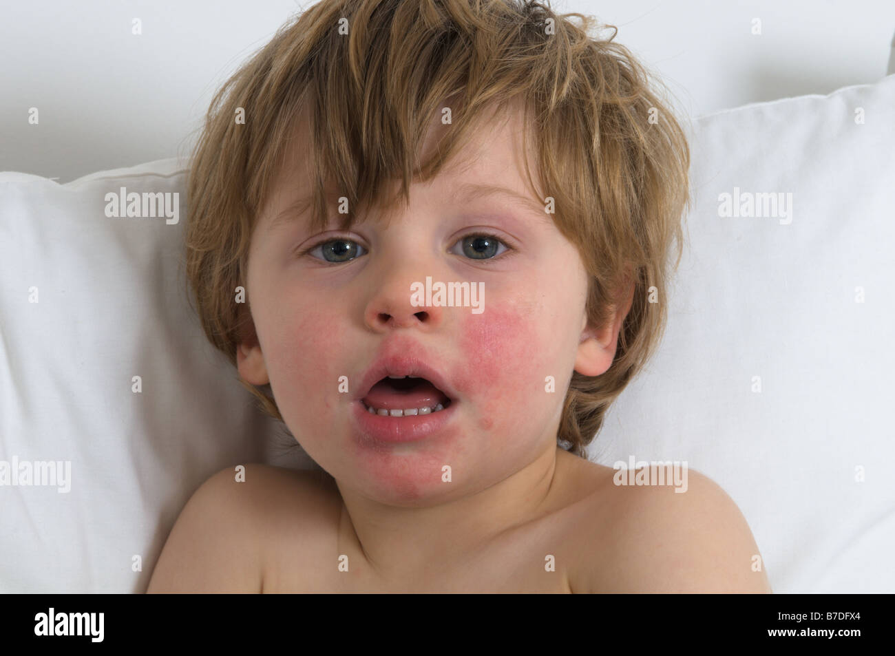 Child Rash Face High Resolution Stock Photography and Images Alamy