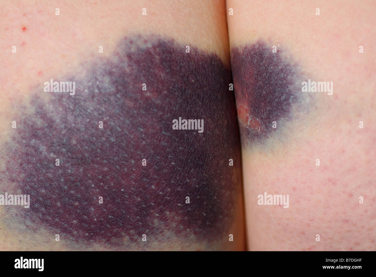large bruise on a woman's bum or buttocks or behind or ass Stock Photo