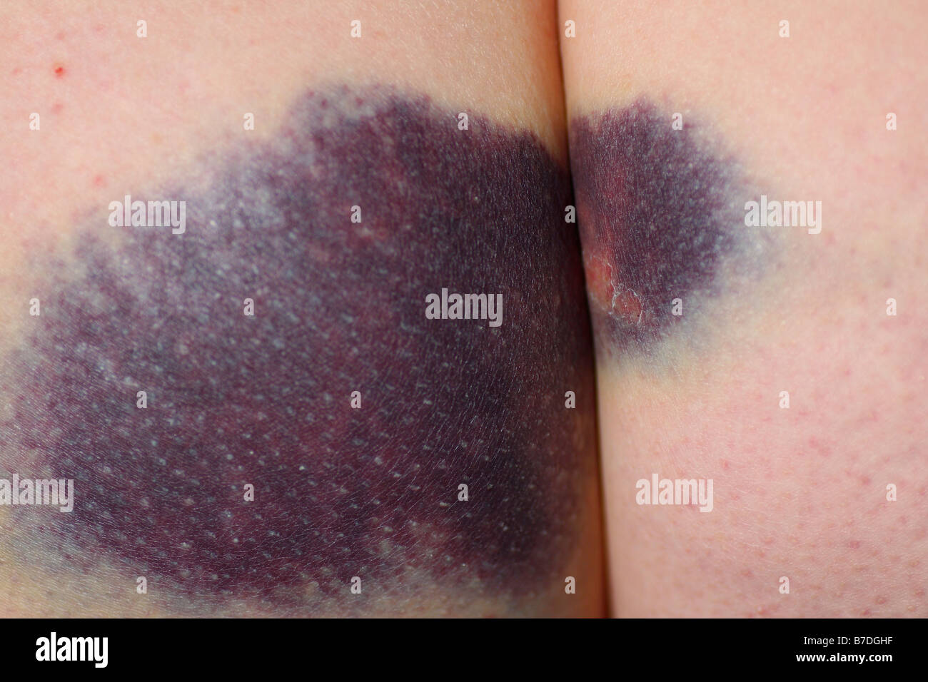 severe bruise ass Severe bruise ass
