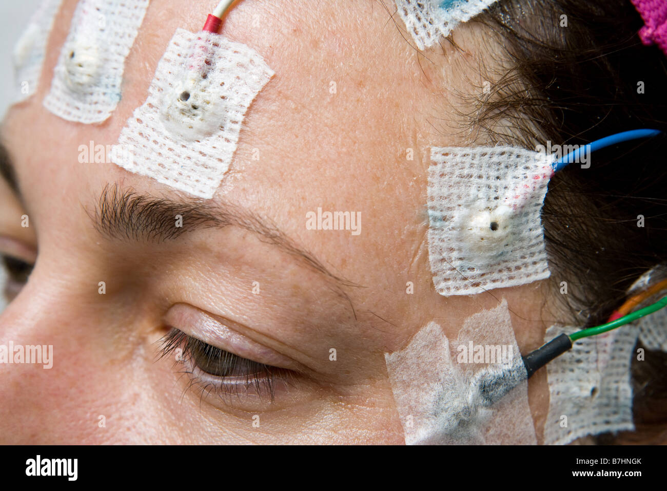 A woman being monitored in an epilepsy monitoring unit Stock Photo Alamy