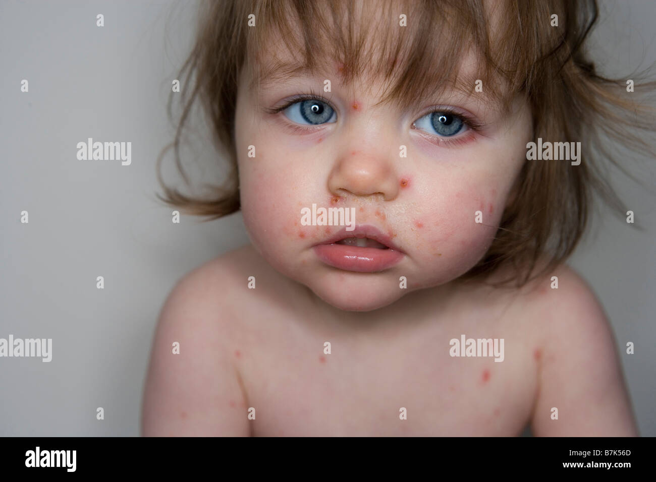 Baby with chickenpox hires stock photography and images Alamy