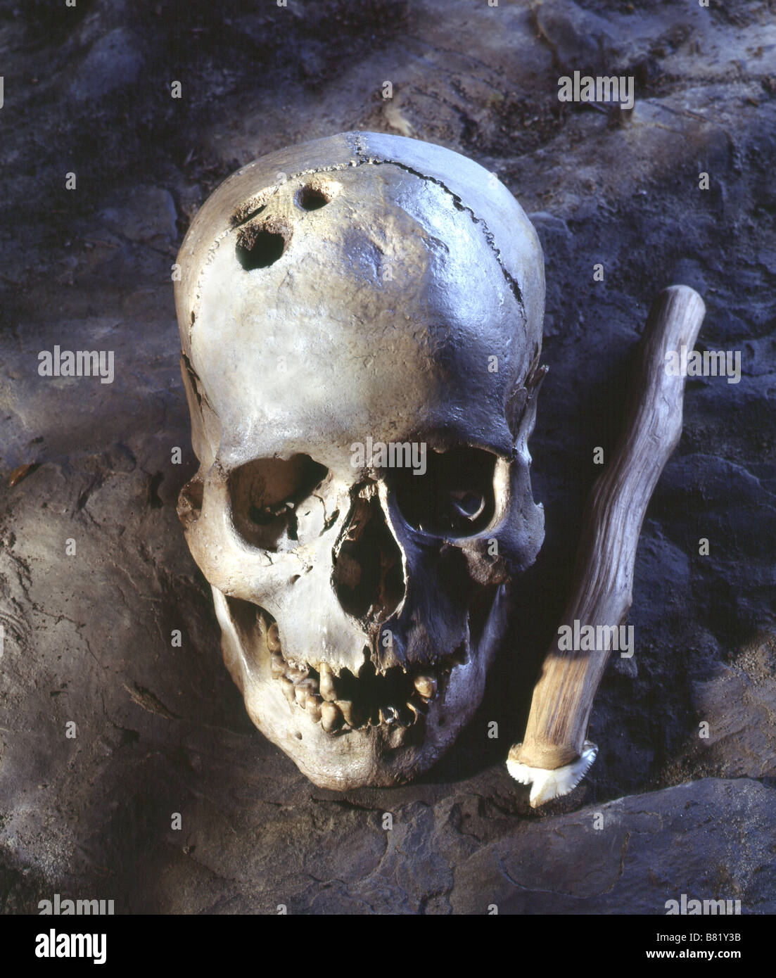 This Skull is the subject of a ancient surgery technique called Trephination. Stock Photo
