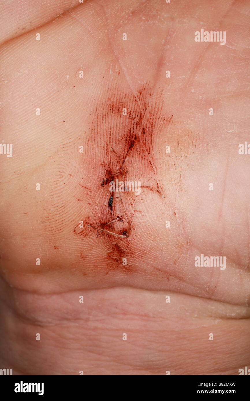 April 2008 - Close in near Macro of post operation scaring following an operation for Carpel Tunnel surgery Stock Photo