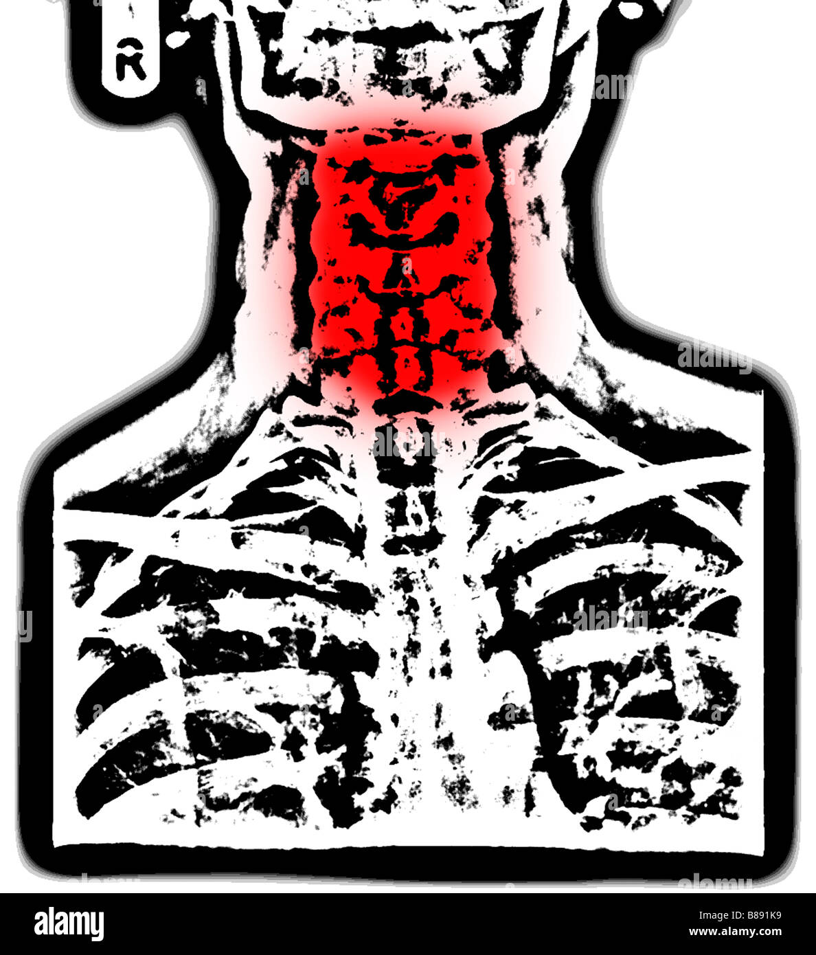 Xray of human upper body illustrating problems with the neck Stock Photo