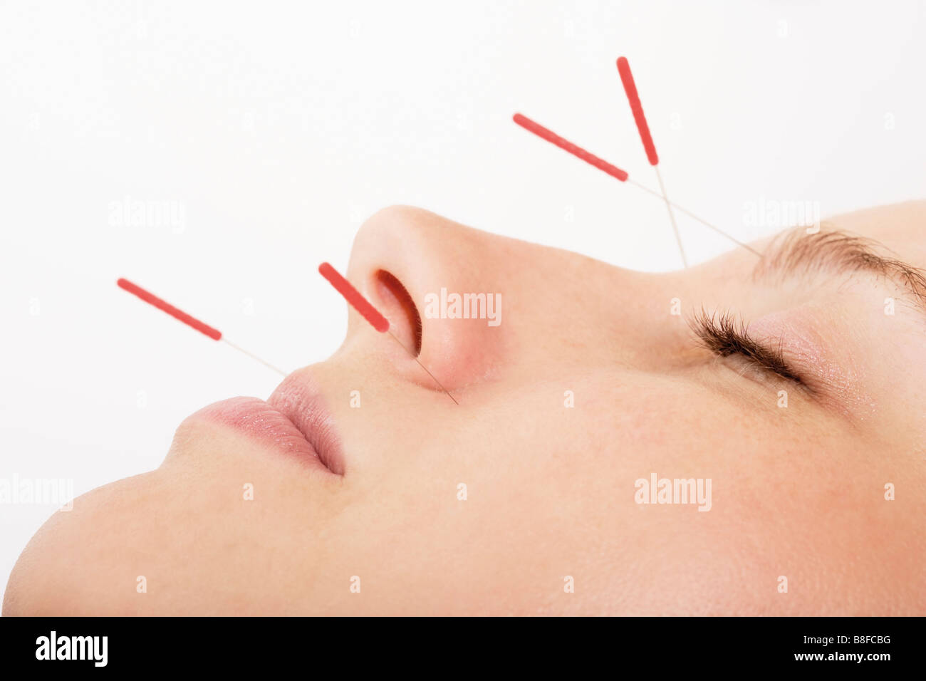 Woman with acupuncture needles in her face Stock Photo Alamy