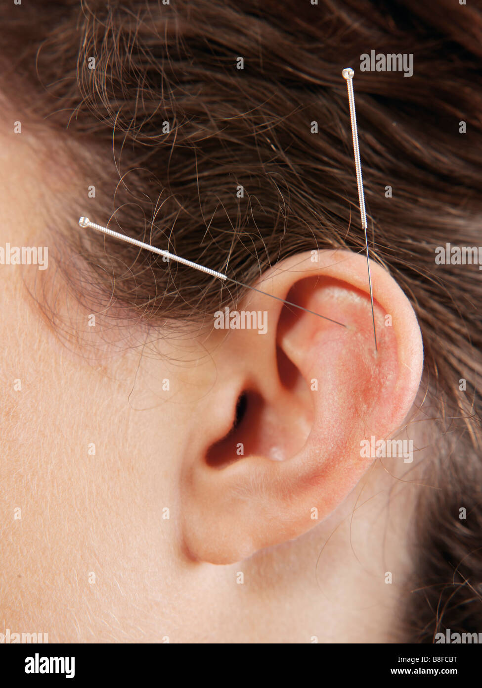 Acupuncture needles in the ear Stock Photo Alamy