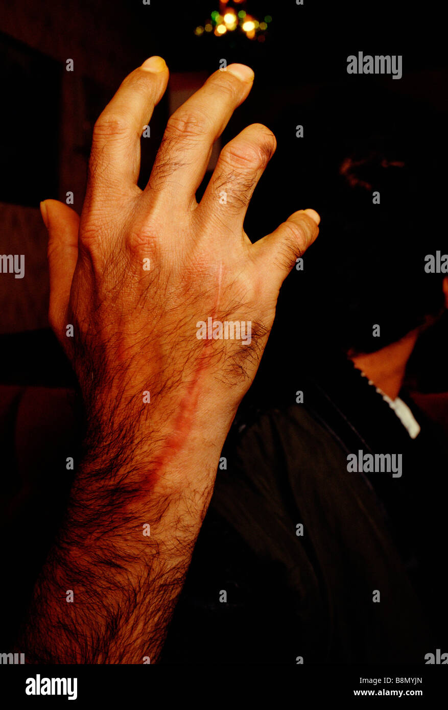 Brick Lane, London, England: An Asian victim of a racist attack displays the scar left on his hand. Stock Photo
