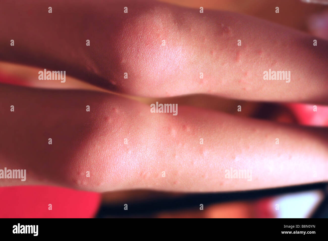 2 Year Old Child's Legs Showing Allergic Reaction to Medicine (Amoxicillin) Stock Photo
