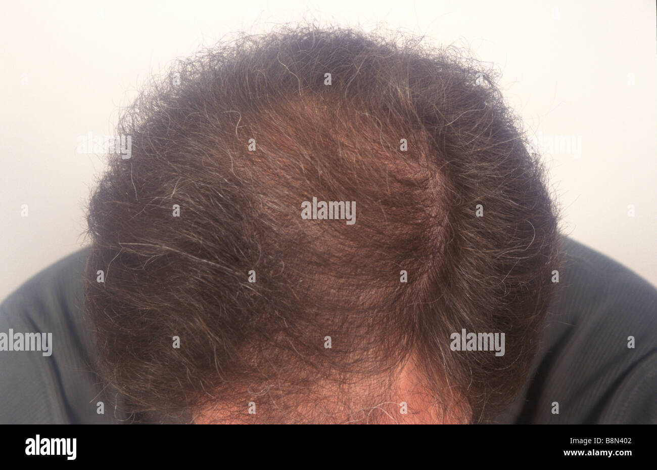 detail of the top of a man s showing thinning on the scalp Stock Photo - Alamy