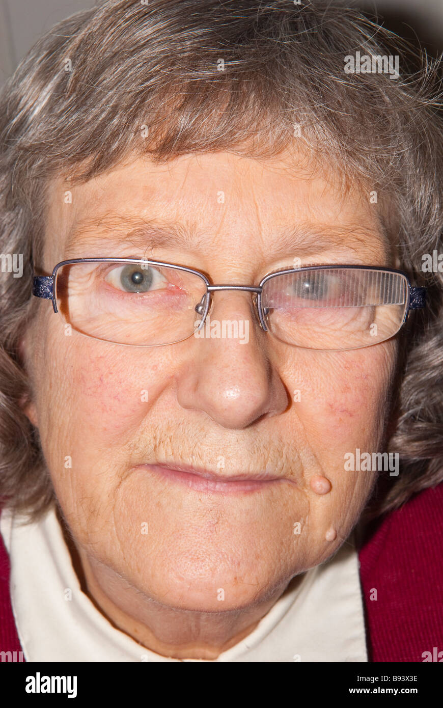 Sixth nerve palsy hires stock photography and images Alamy