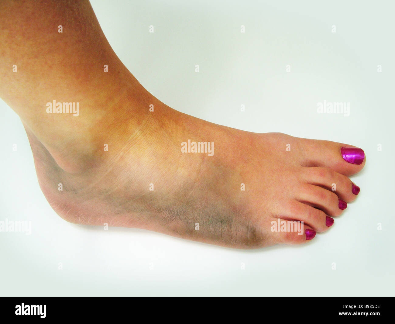 Swollen Ankle Stock Photos & Swollen Ankle Stock Images - Alamy