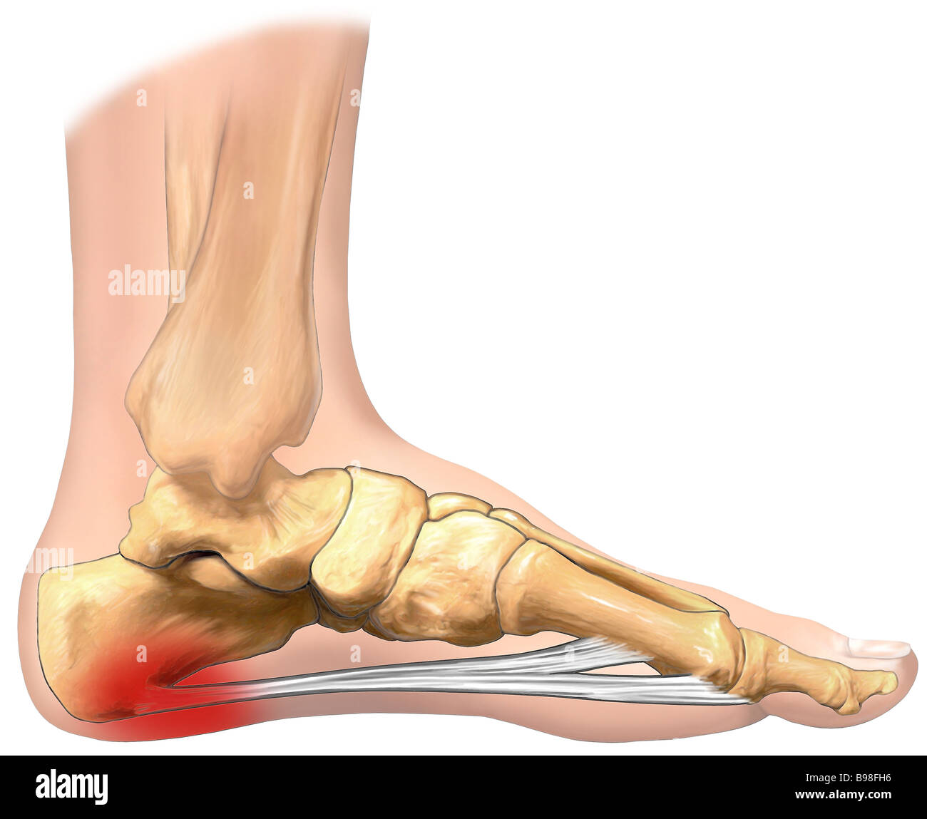 Бурсит ахиллового сухожилия. Боль в колене при ходьбе. Плантарный фасциит стопы. Хондропротекция. Переразгибание в тазобедренном суставе.