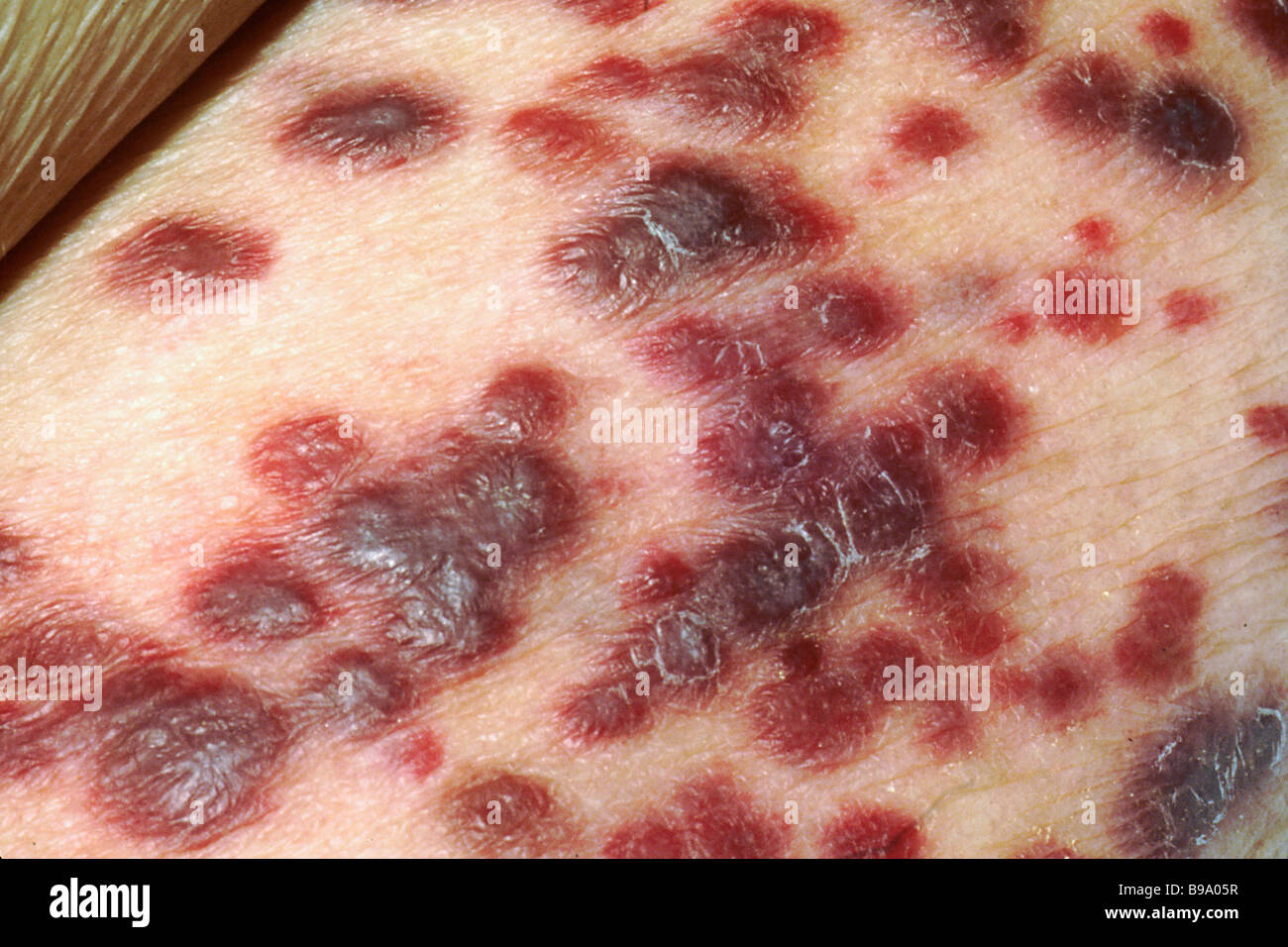 Kaposi sarcoma on the skin of an AIDS patient Stock Photo