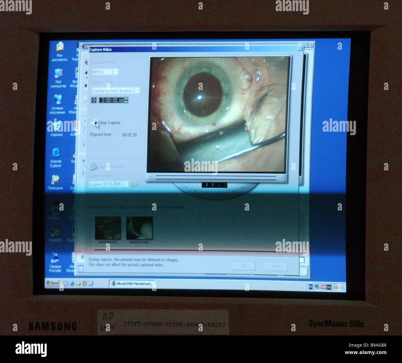 Eye surgery replacing a damaged eye lens with an artificial one The