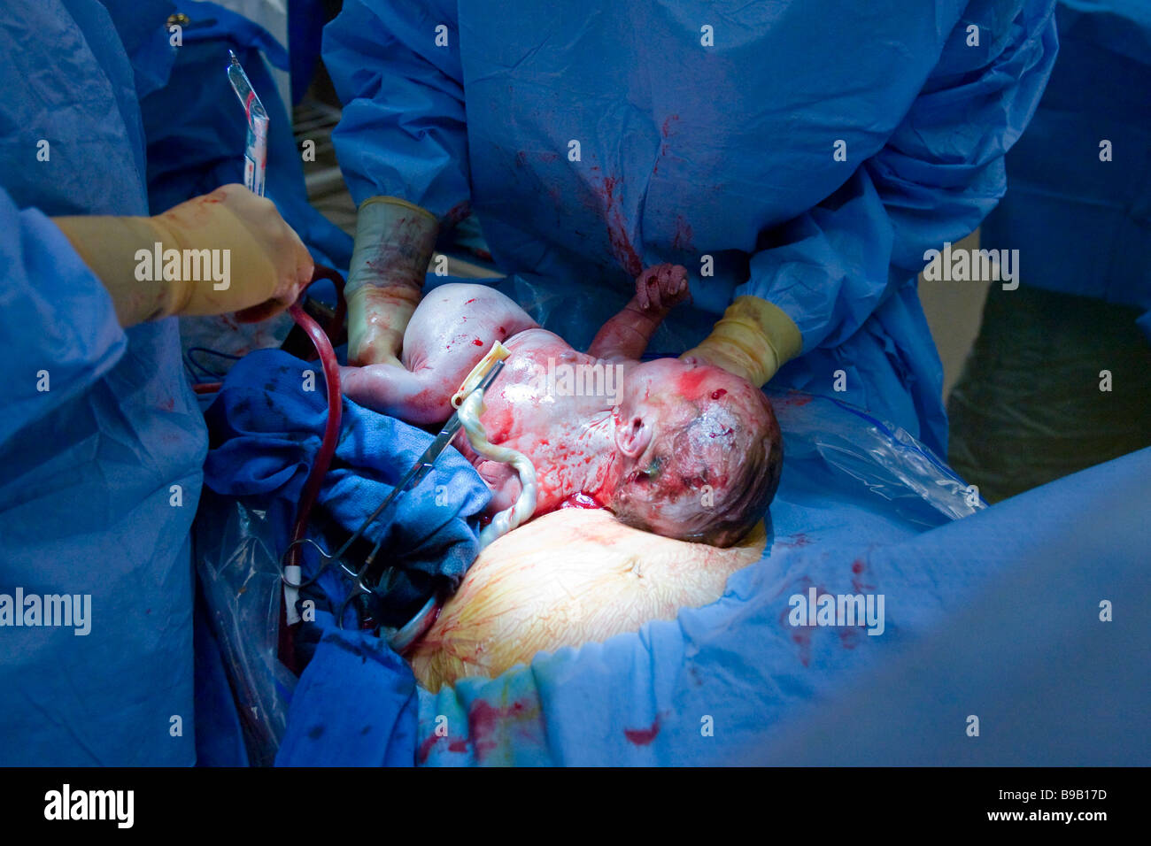 Baby being delivered by caesarean section. Stock Photo
