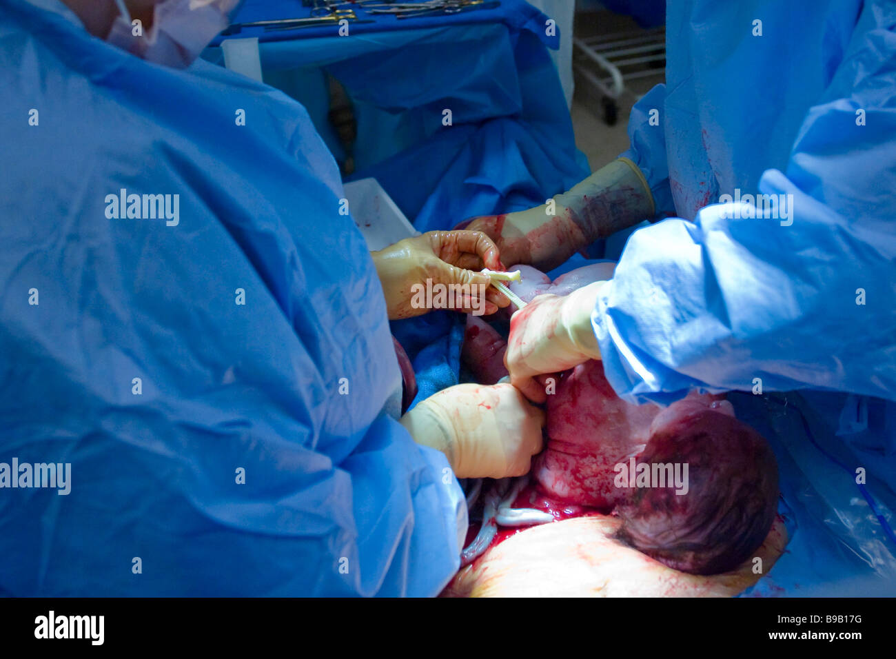 Baby being delivered by caesarean section Stock Photo