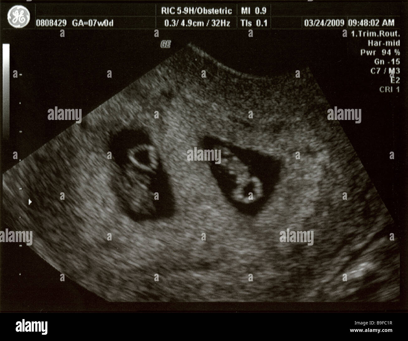 Ultrasound showing foetal development of fraternal twins at 7 weeks, conceived through IVF. Stock Photo