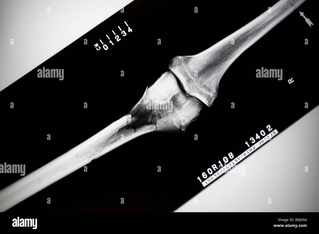 X-ray of broken leg Stock Photo