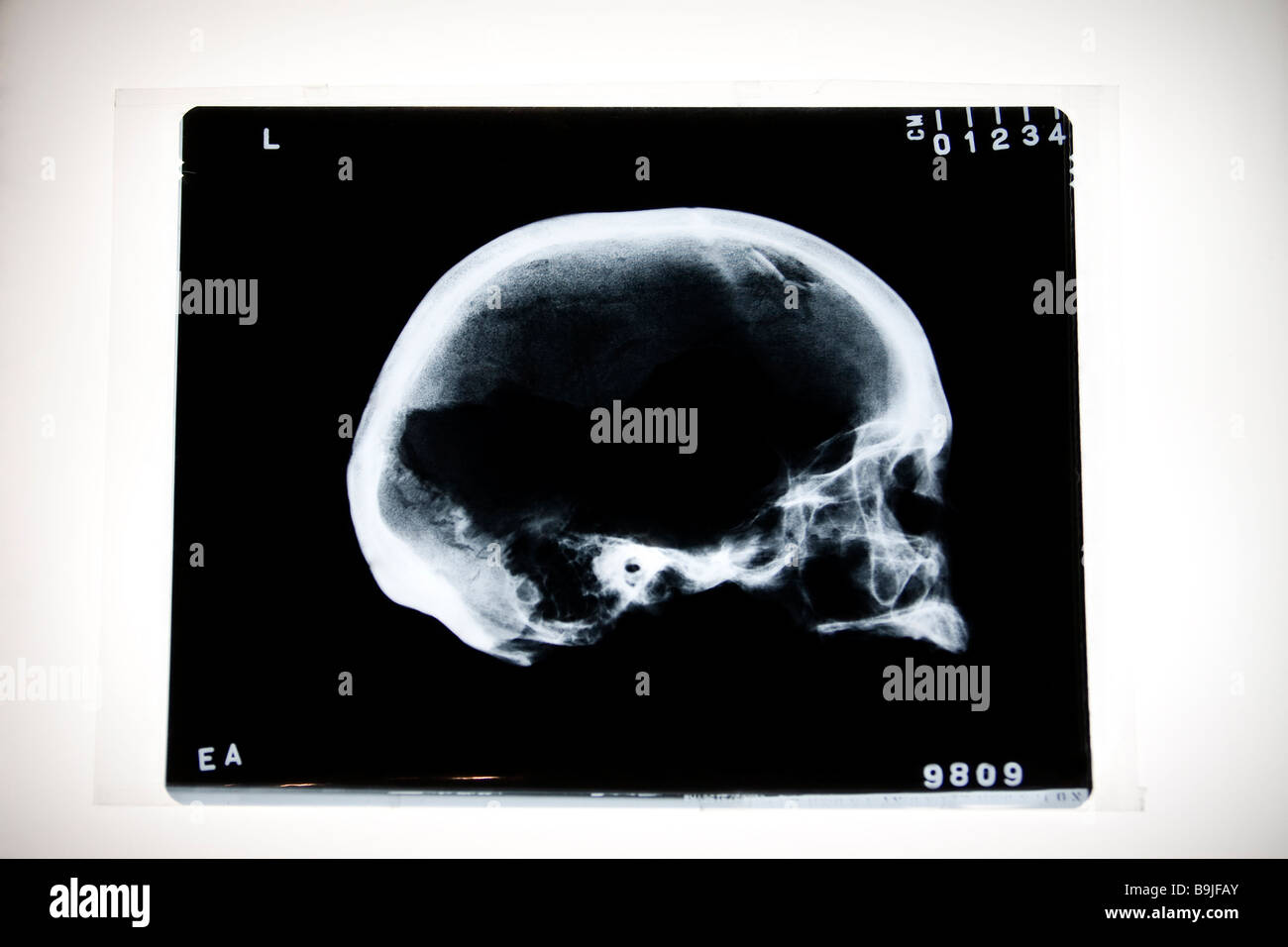 X-ray of human skull with blunt fracture Stock Photo