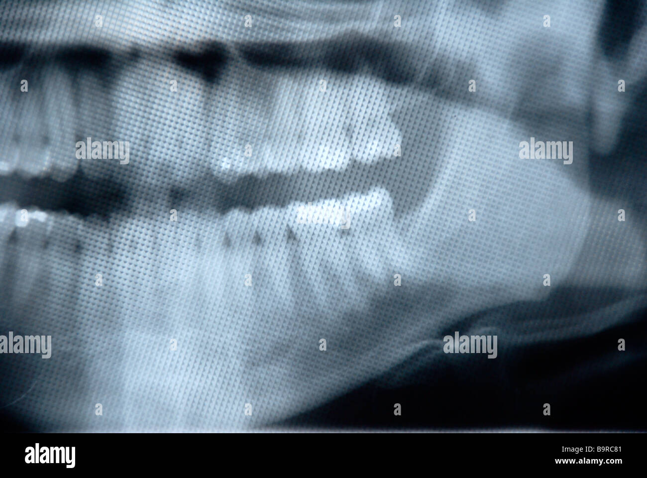 Partially Bone Tooth In. X Rays Tooth decay x ray hi-res stock photography and images - Alamy