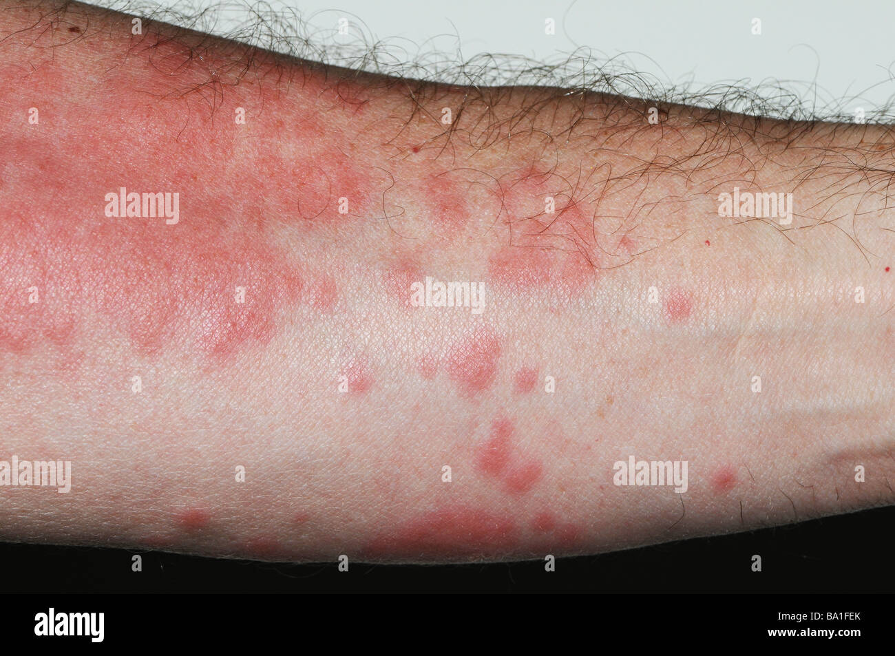 close up of rash on arm from Portuguese Man o' War (Physalia physalis), also known as the blue bubble, blue bottle, man-of-war Stock Photo