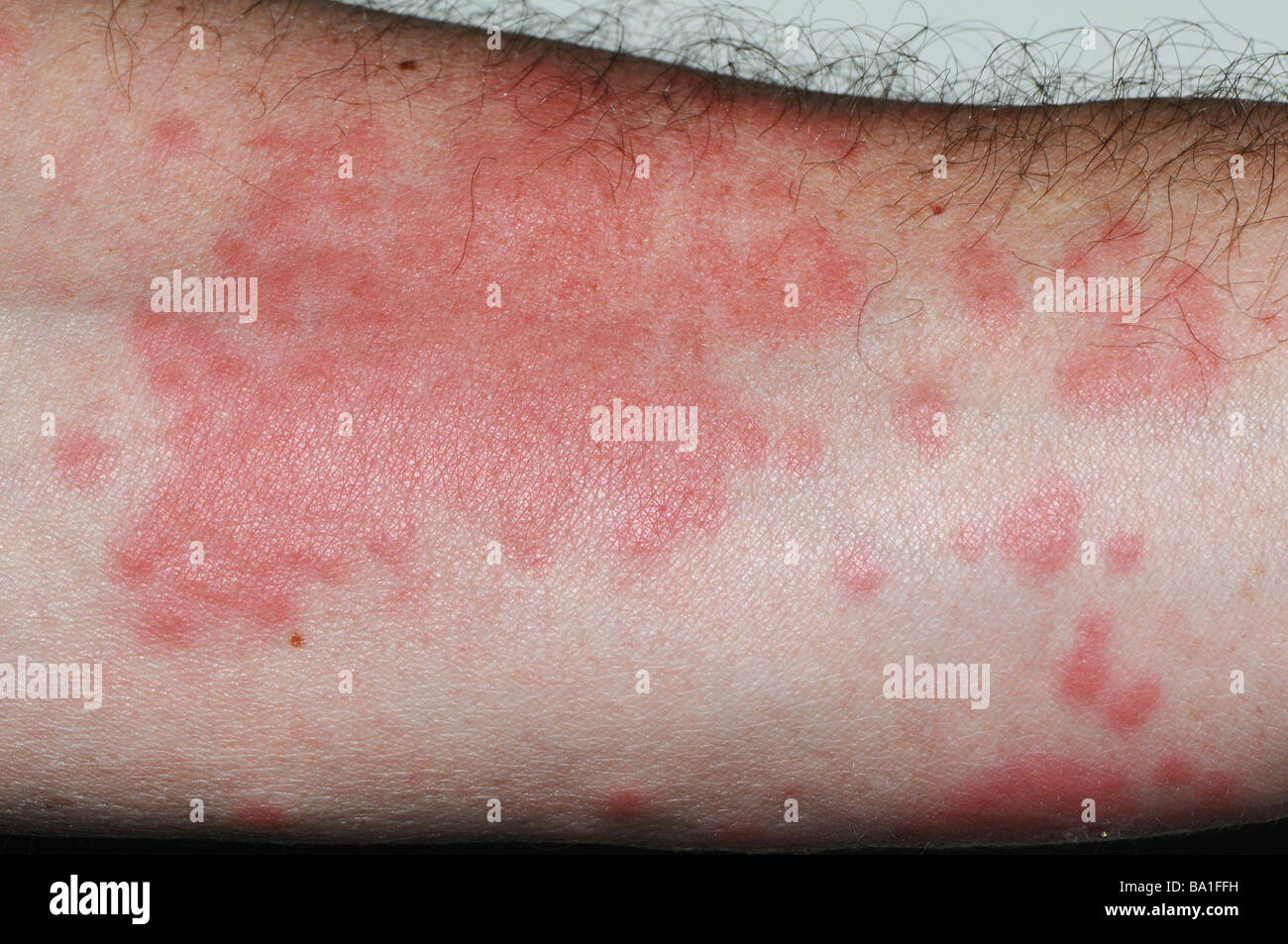 close up of rash on arm from Portuguese Man o' War (Physalia physalis), also known as the blue bubble, blue bottle, man-of-war Stock Photo