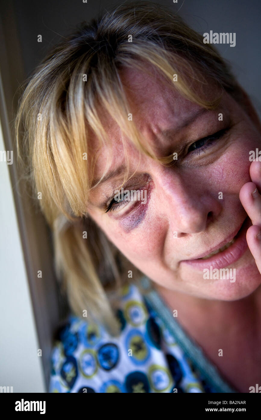 A battered abused wife with a black eye Picture Posed by Model Stock Photo