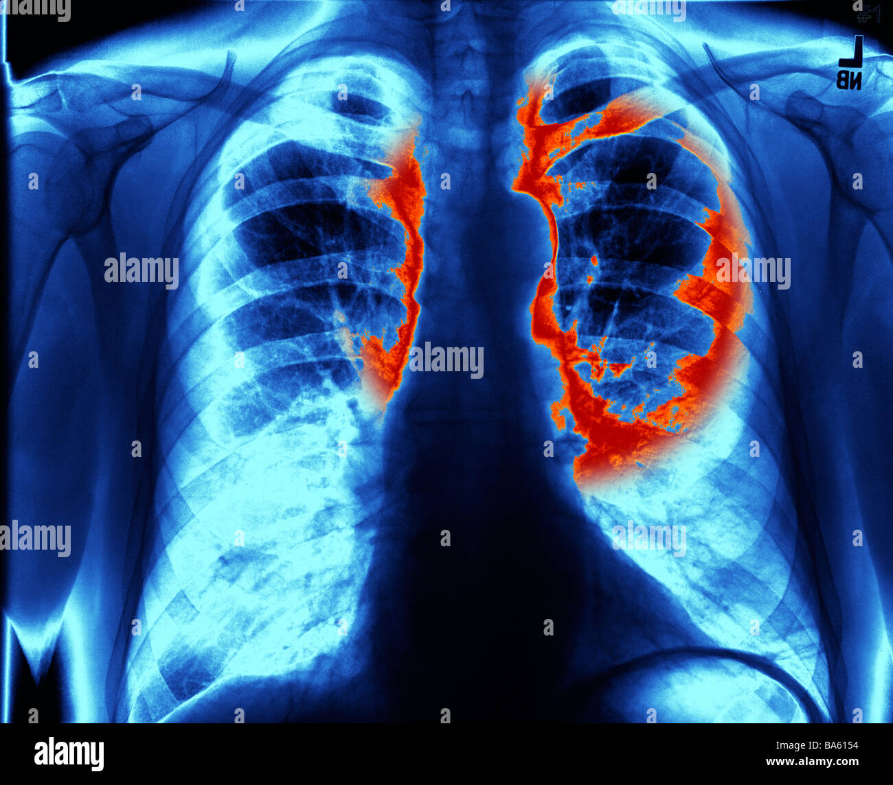 xray of lung infection shown in red Stock Photo Alamy