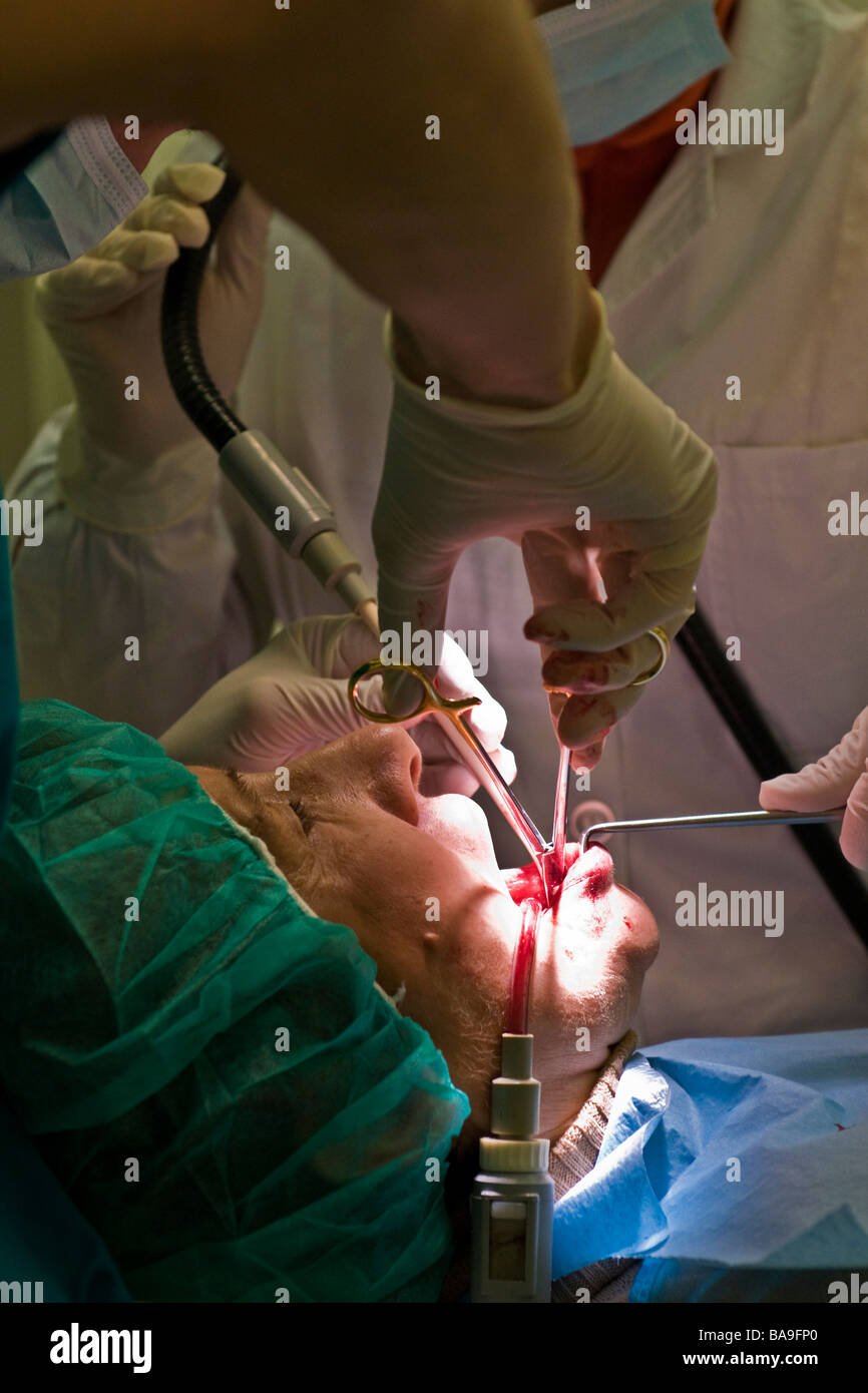 dental implantology Stock Photo