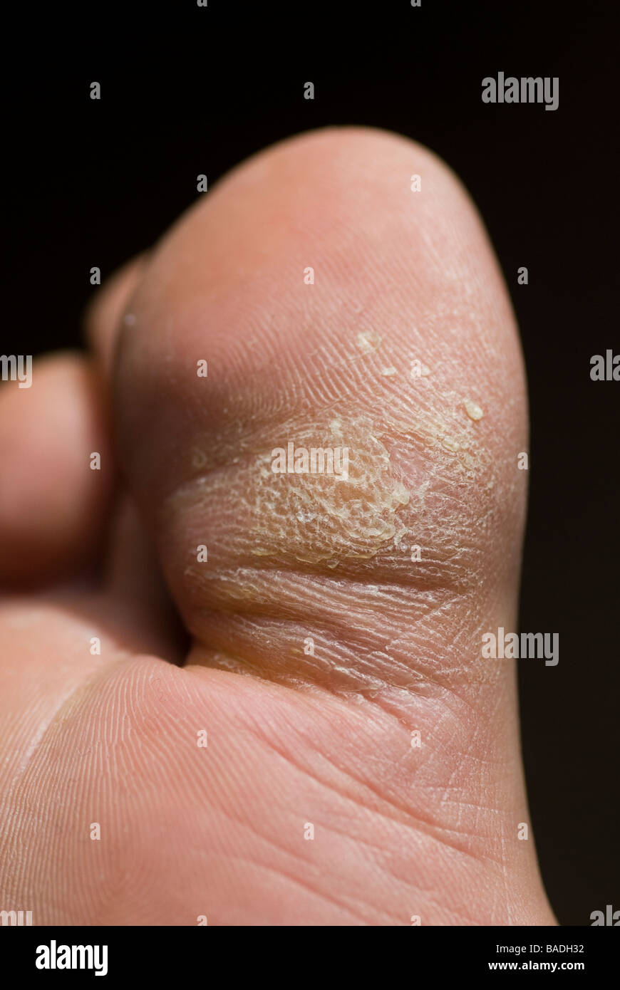 Close up of cracked skin of man's toe Stock Photo