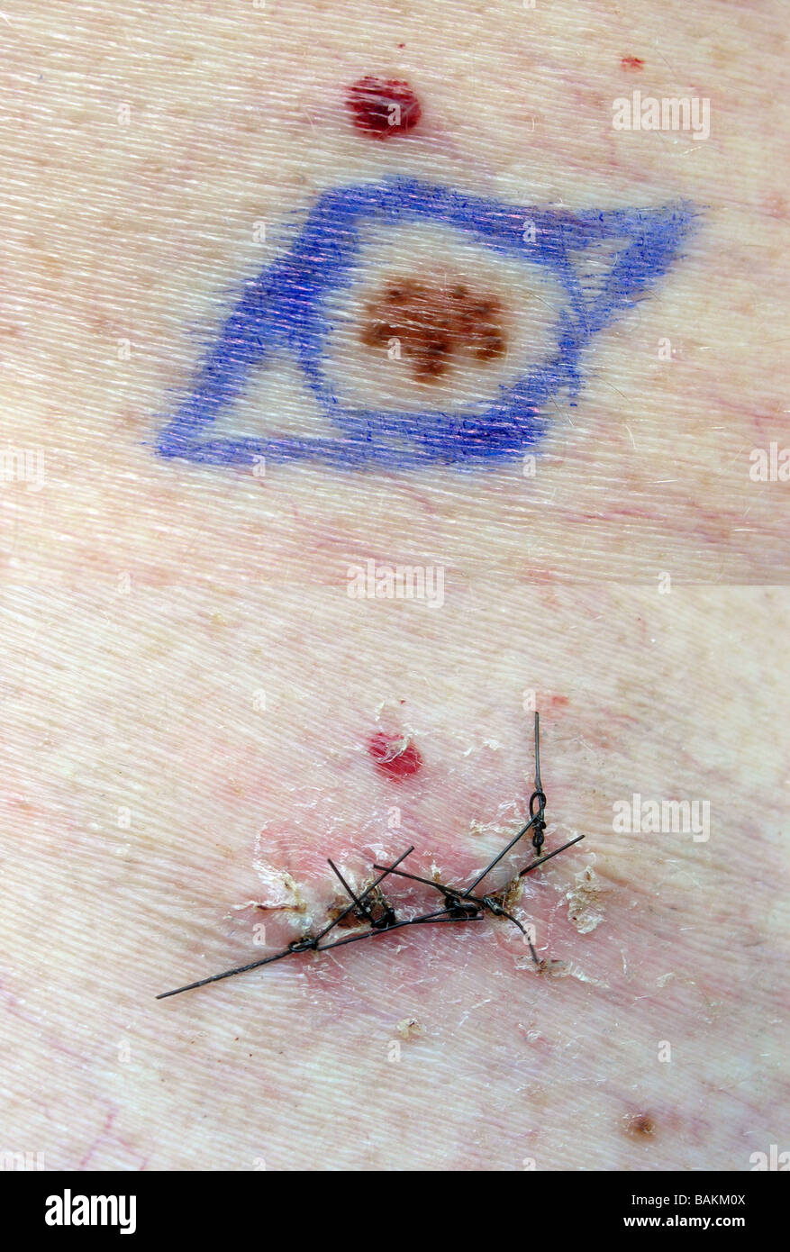 Composite of before and after shots of a mole removal to check for melanoma skin cancer Stock Photo