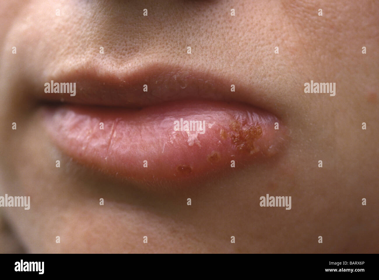 close-up of a woman's lips with a cold sore, coldsore,  inflammation on bottom lip Stock Photo