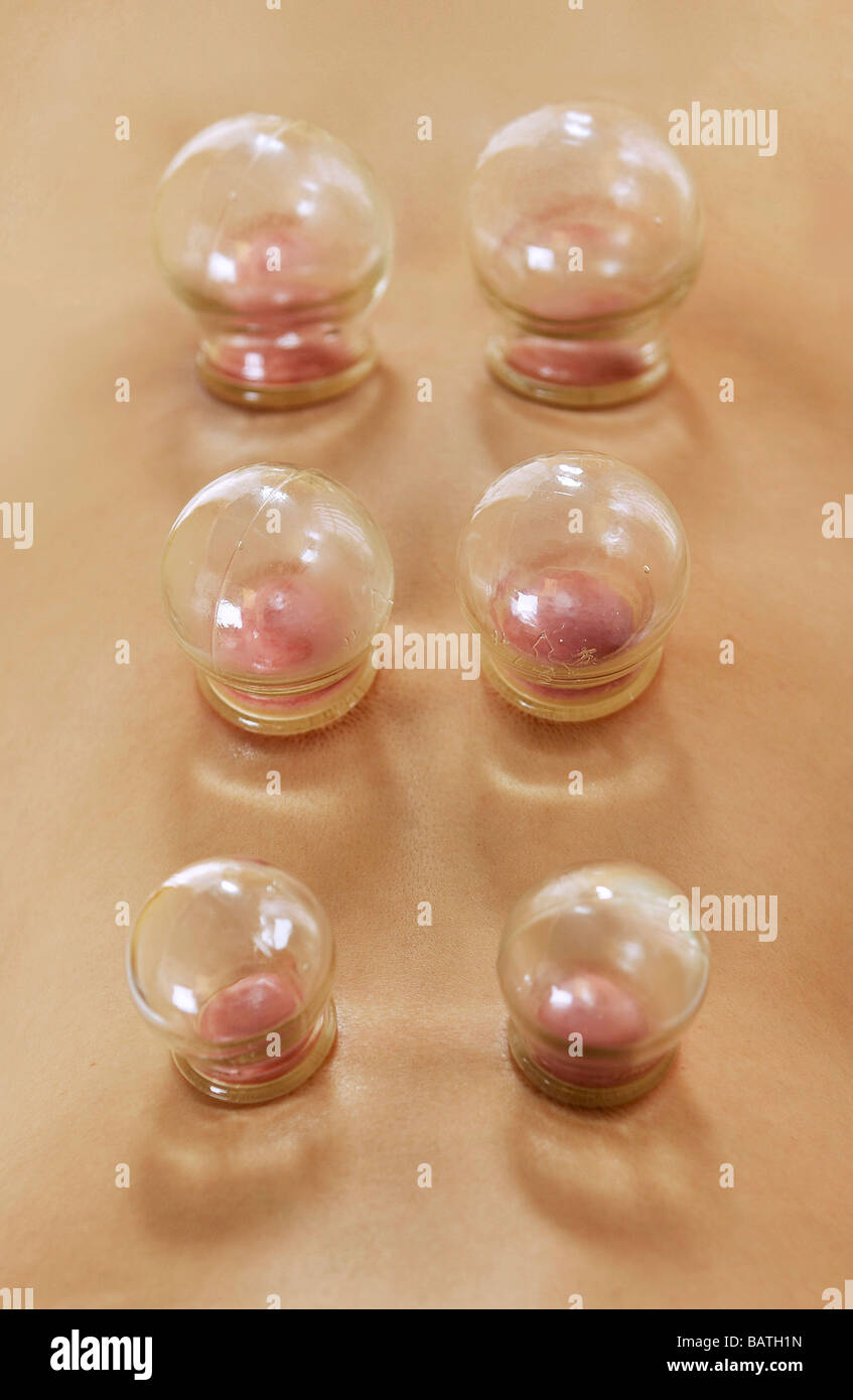 Cupping chinese treatment hires stock photography and images Alamy