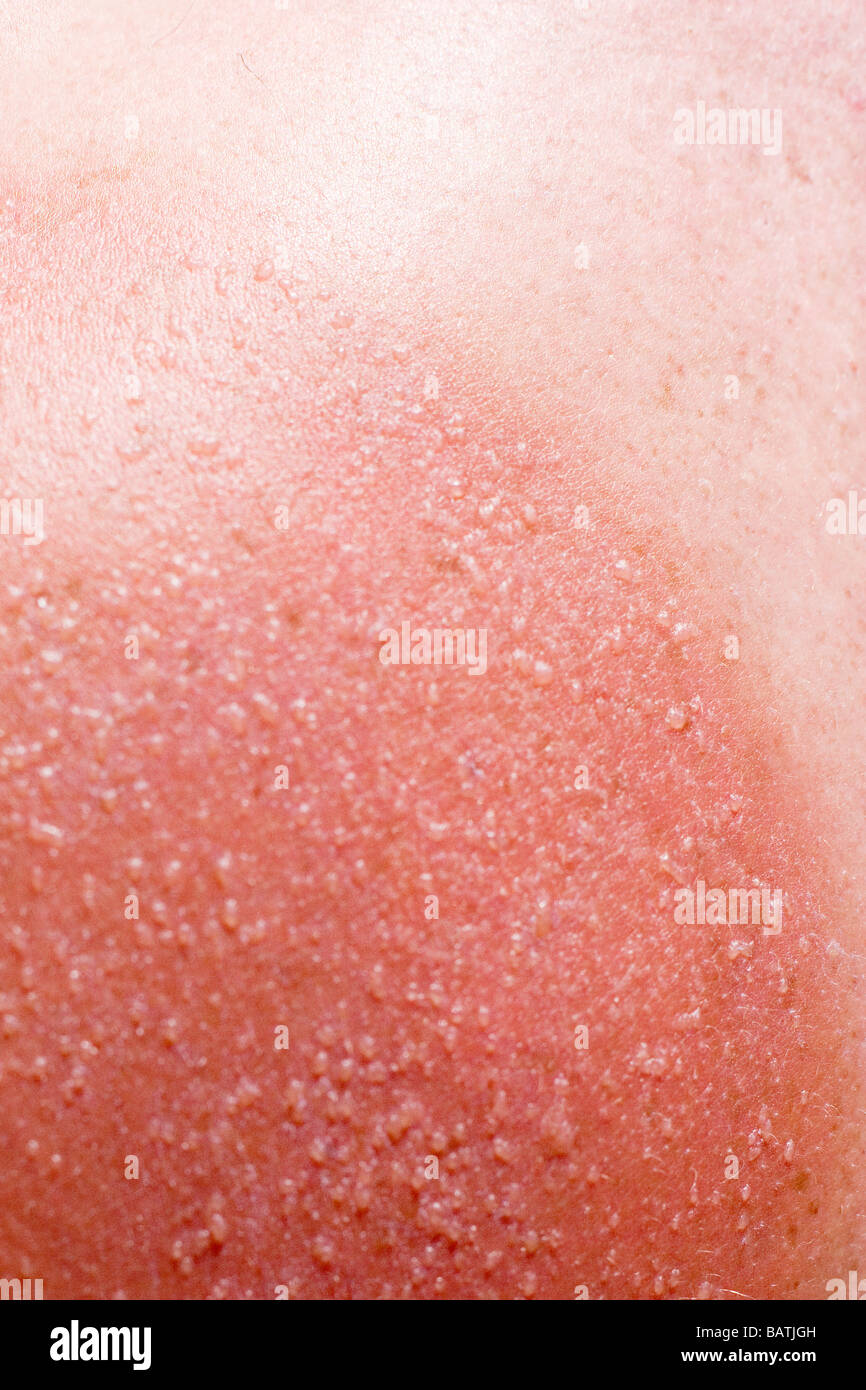 Sunburnt skin on a man'sshoulders. Sunburn is caused by overexposure to sunlight. Stock Photo