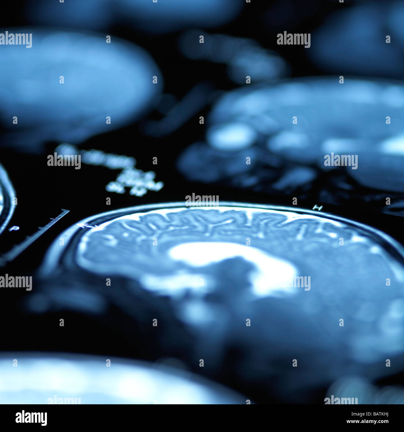 Normal Brain Scan Stock Photos & Normal Brain Scan Stock Images - Alamy